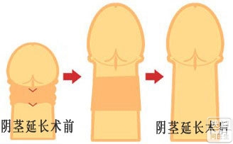 道县较好男科医院做阴茎延长手术后会产生副作用吗