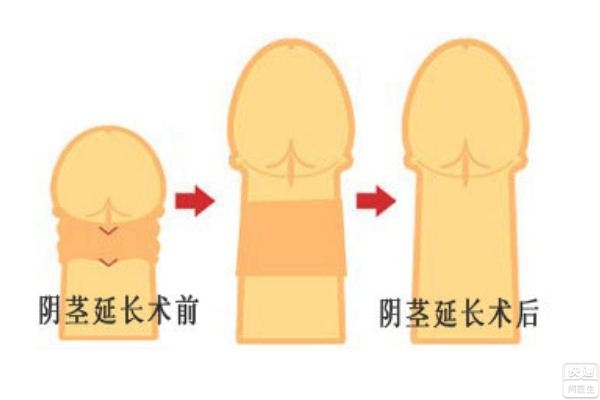 道县较好男科医院小阴茎怎么保证性生活质量？